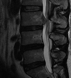 Sequestered Disc MRI 2